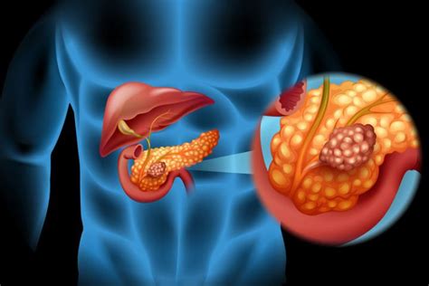 elastaza pancreatica in materii fecale|Elastaza pancreatica in materii fecale